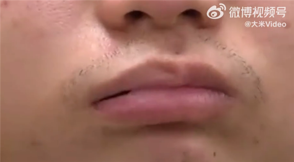 熬夜再添新隐患，24岁江苏小伙熬夜加班后嘴果真歪了